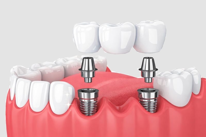 Dental Implants Restoration