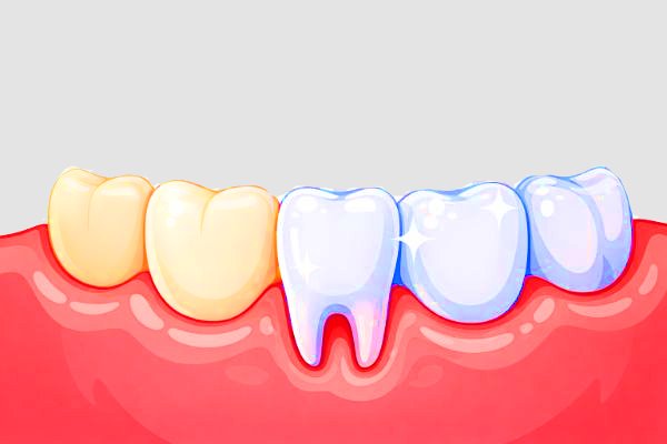 Teeth Whitening